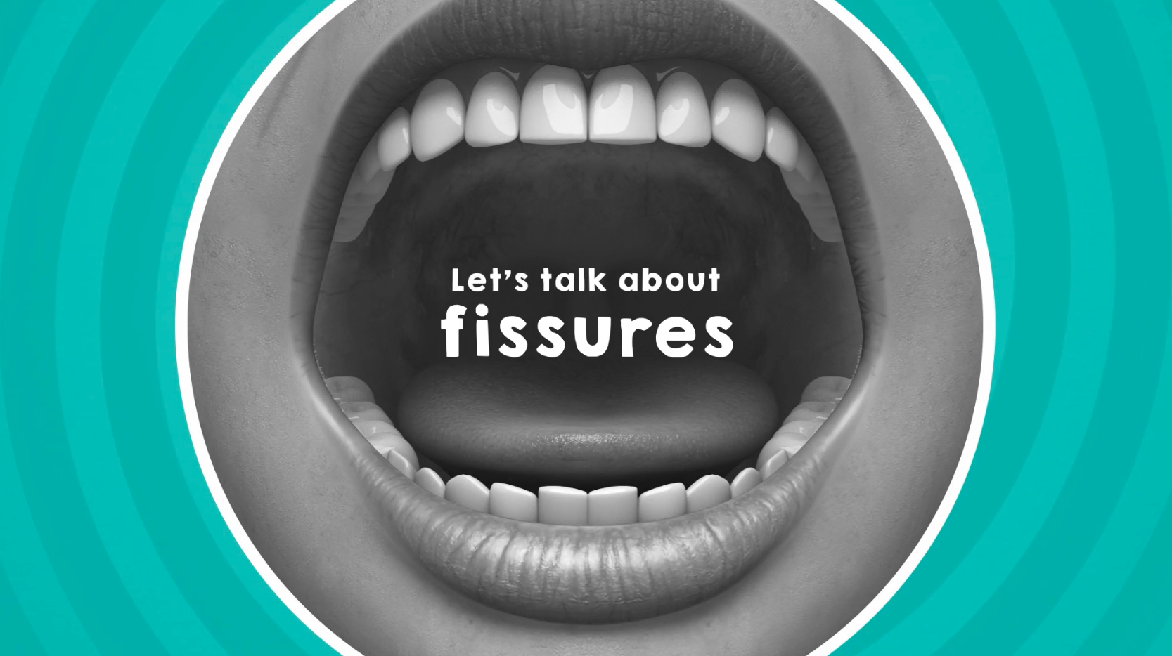 Fissure Seals at any age